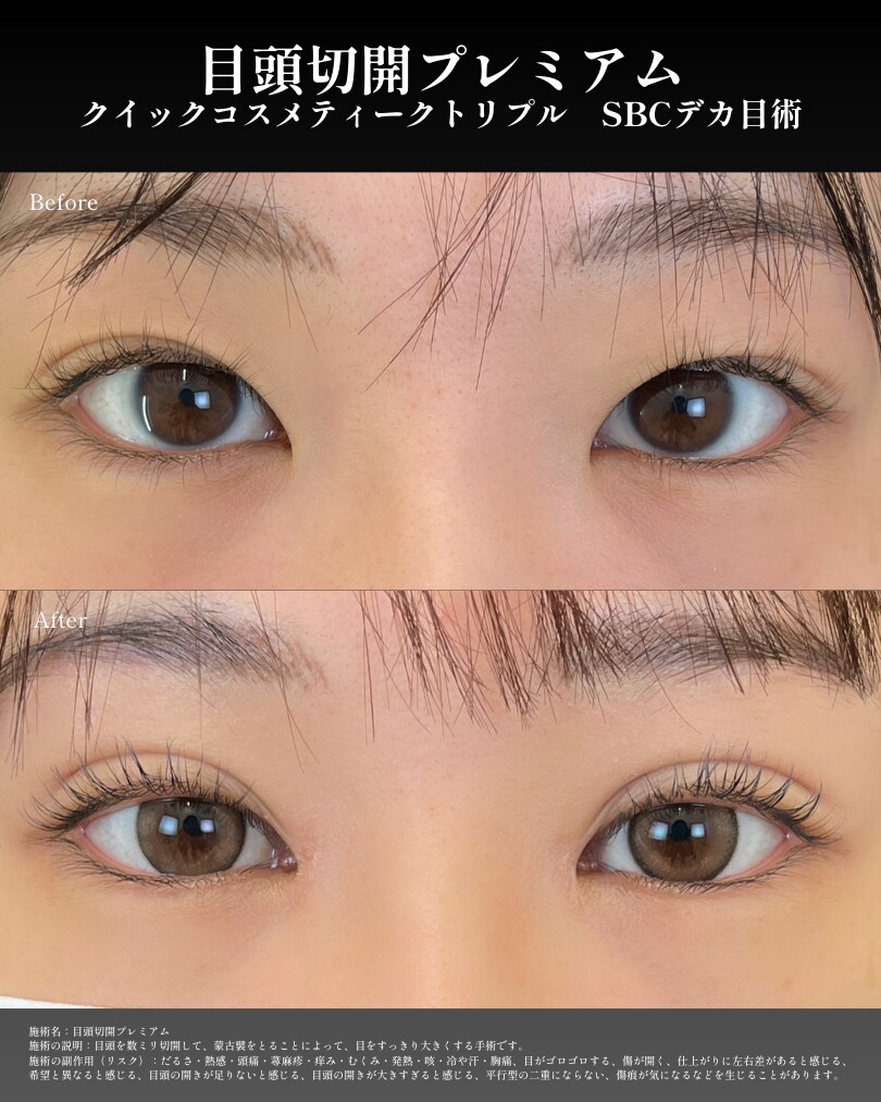 Mix型二重に（二重埋没の修正）