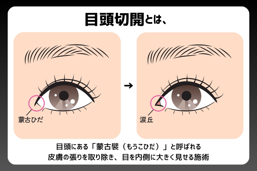 目頭切開プレミアム