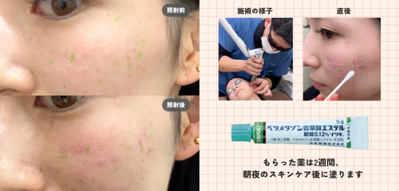 施術前▶︎施術直後