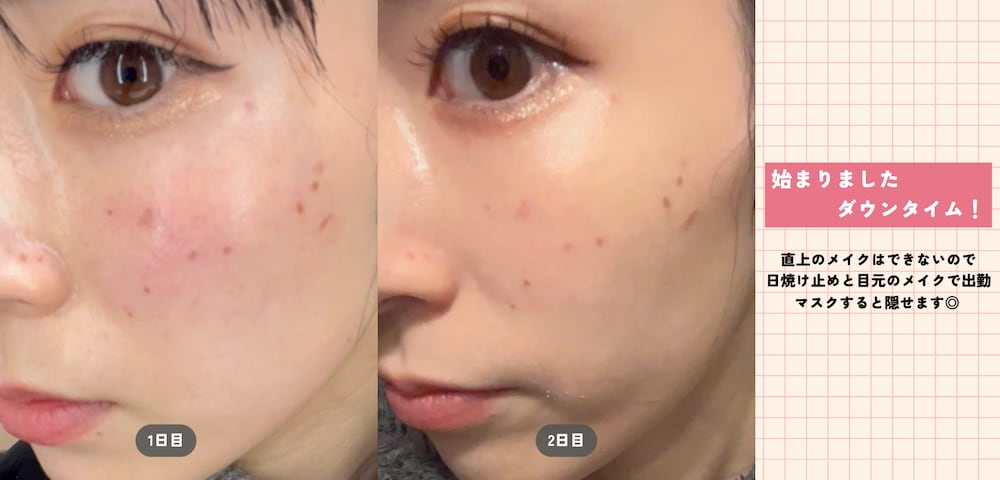 🗓 1〜2日目｜シミが一時的に濃くなる