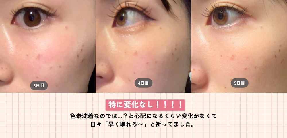 🗓 3〜5日目｜大きさな変化なし