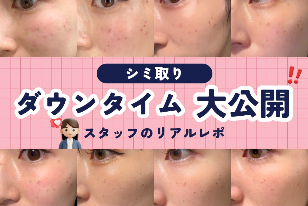 【写真あり】シミ取り(ピコスポット)のダウンタイムを正直レポ|実際どうだった?