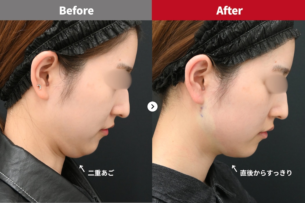 顎下すっきリフトのビフォーアフター