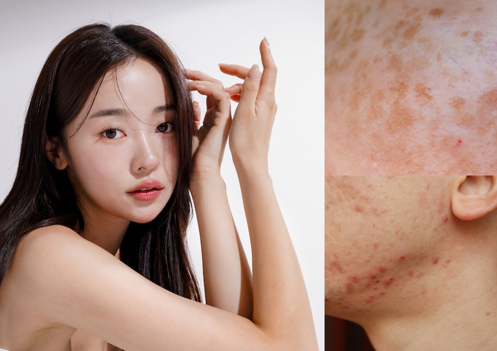 🌿シミ取り・ニキビ治療