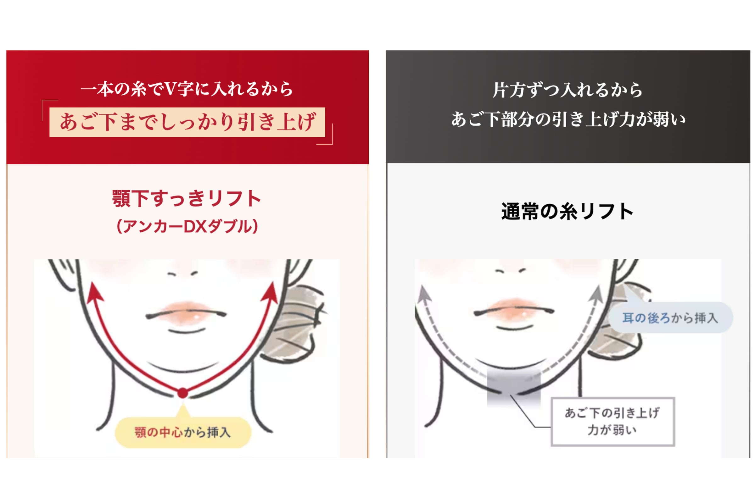 顎下専用の糸リフト