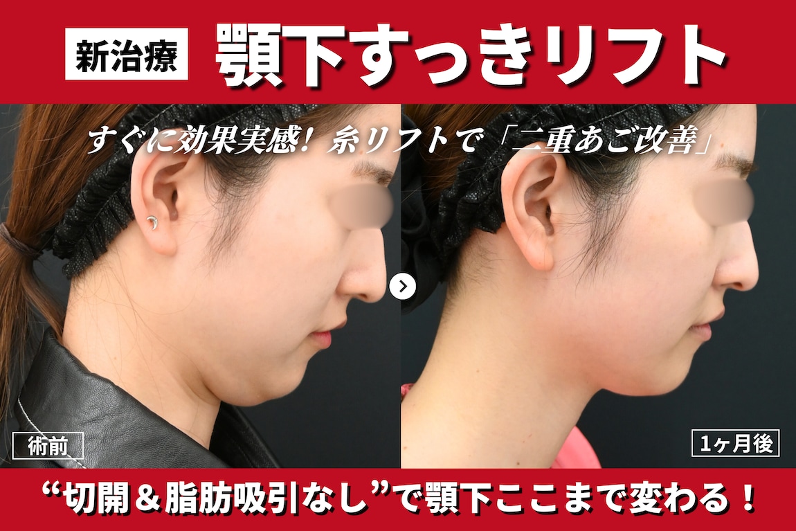 【新治療】切開＆脂肪吸引不要！糸リフトで速攻二重あご改善「顎下すっきリフト」