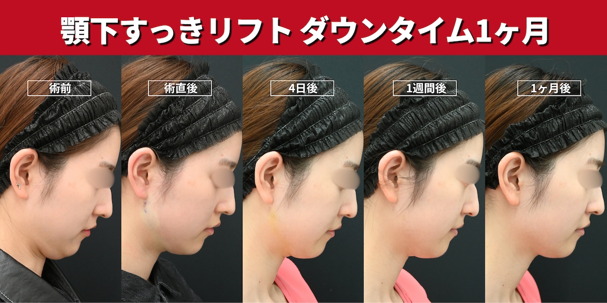 実際のダウンタイム経過写真