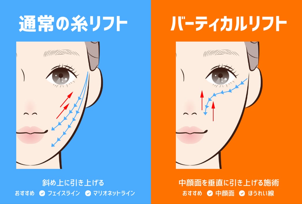 通常の糸リフトとの違い