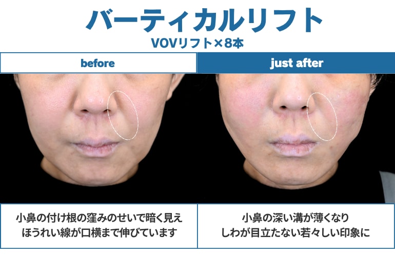 小顔症例実績3,000件以上「糸リフト名医 髙川医師の症例写真」