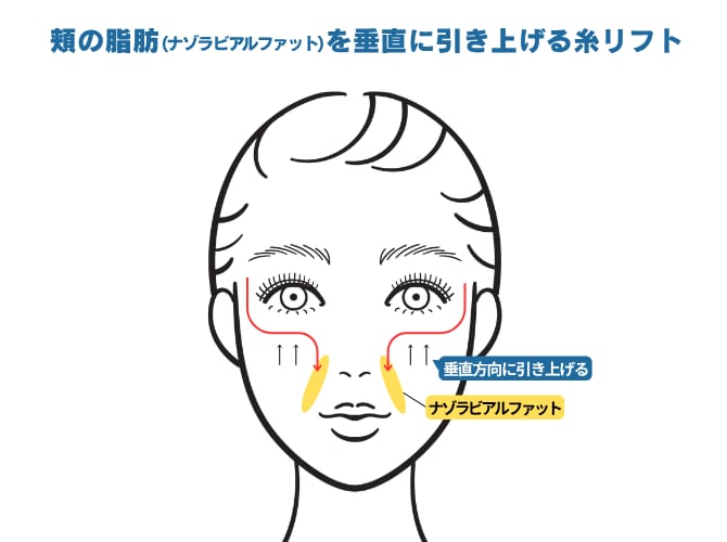 バーティカルリフトについて