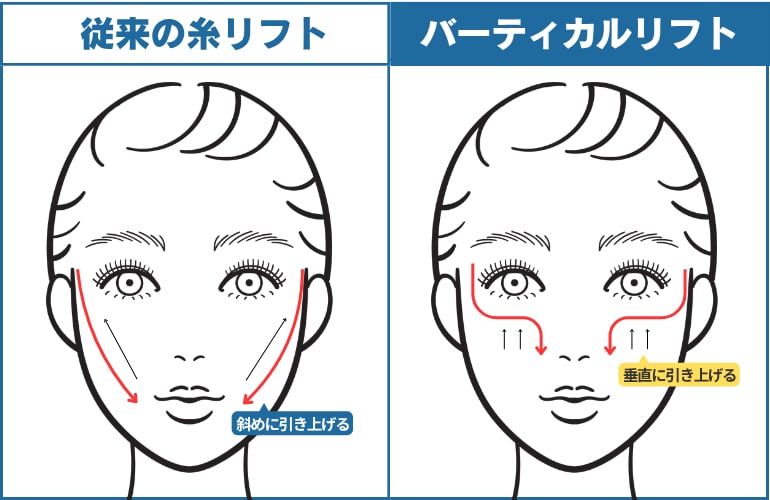 一般的な糸リフトとの違い