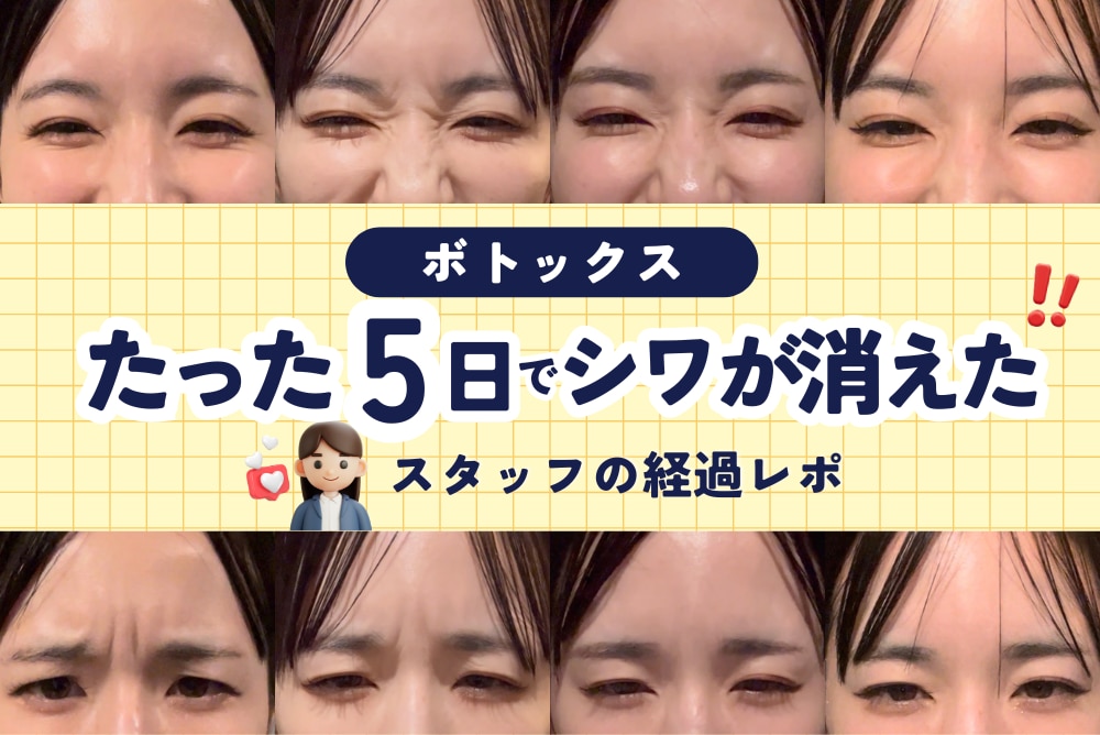 【写真あり】たった5日でシワが消えた！？美容スタッフのボトックス経過正直レポ