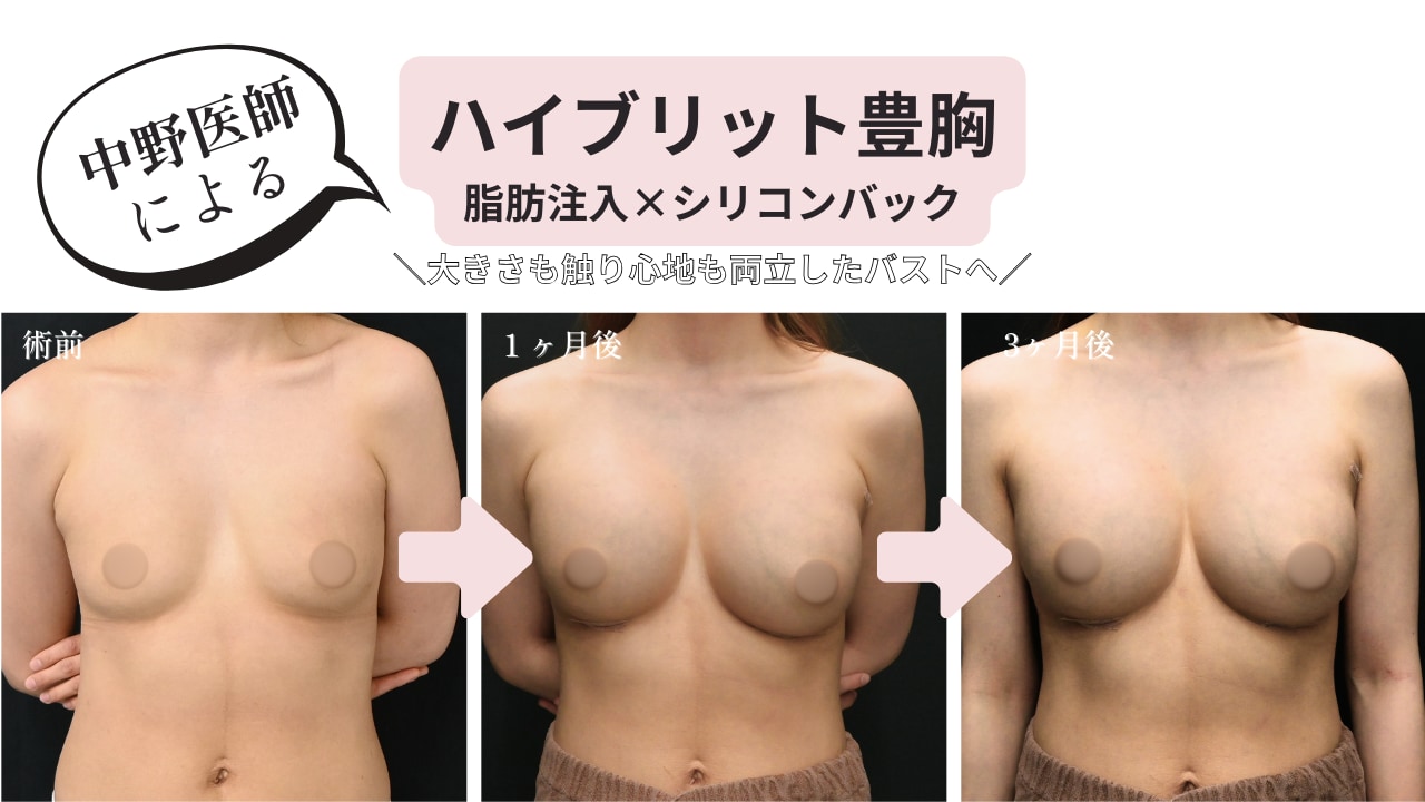 脂肪注入✖️シリコンバック豊胸『ハイブリット』の症例を紹介！