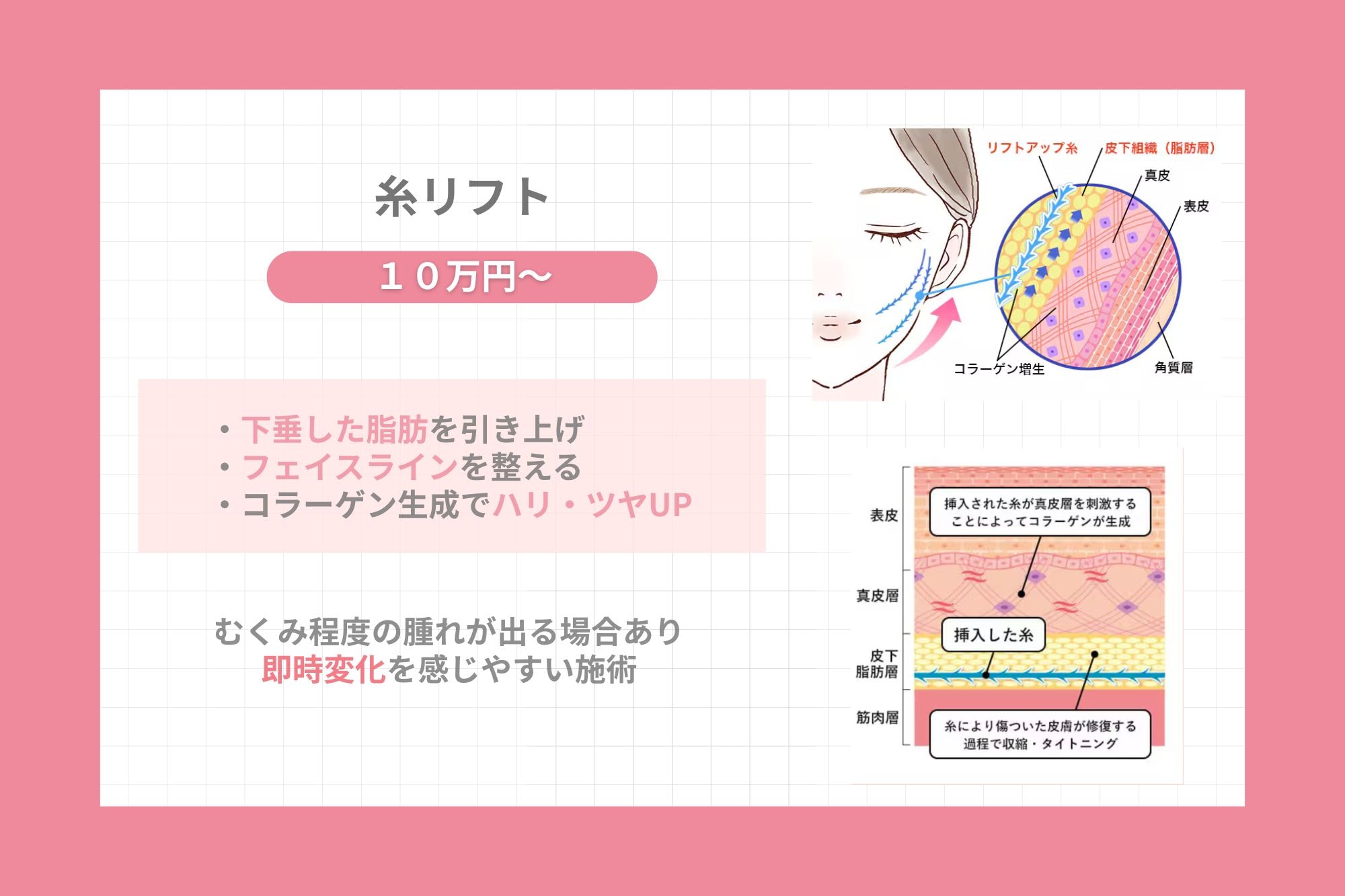 ④糸リフト（VOVリフト）