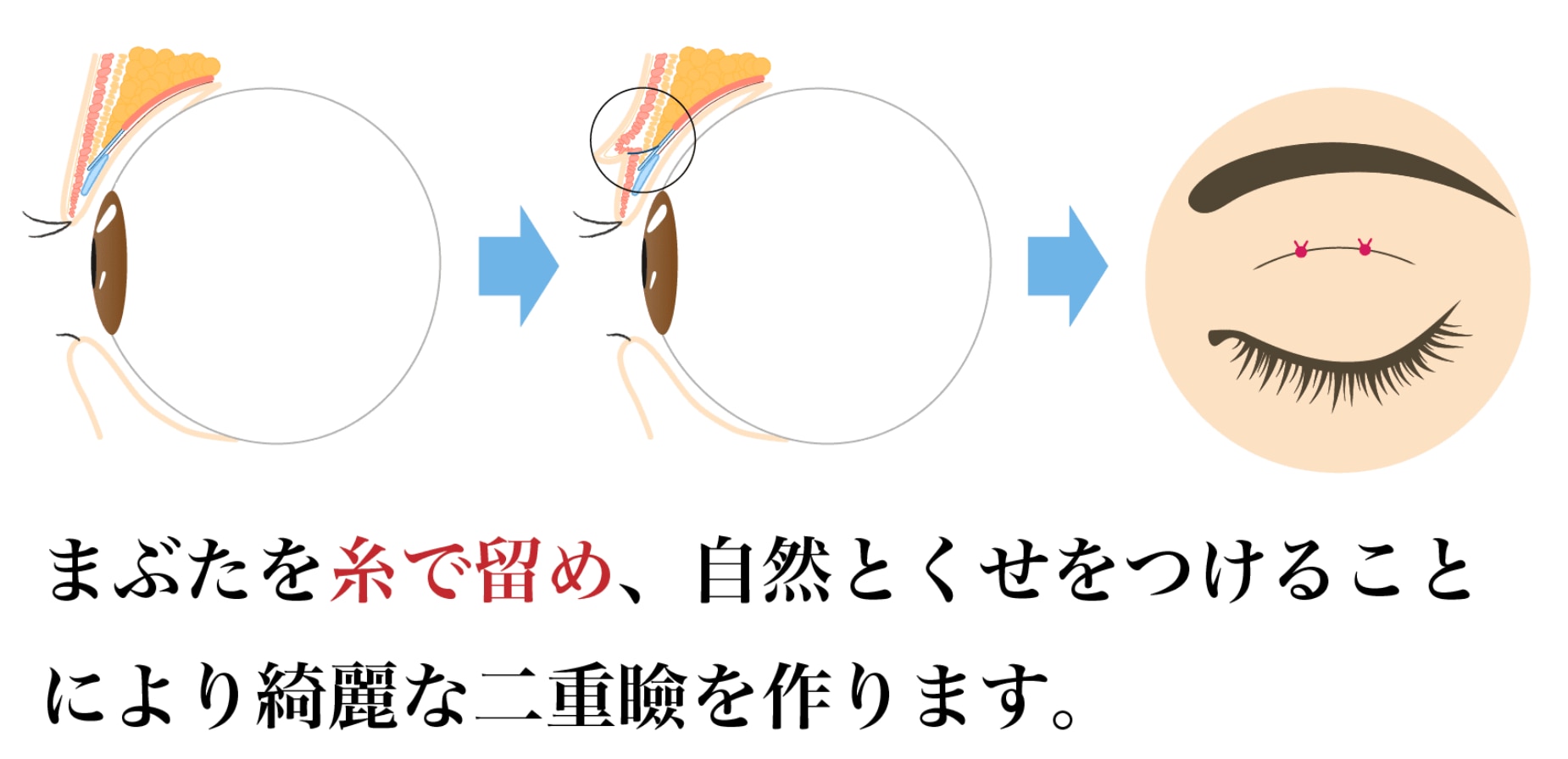 メスを使わず糸による二重術埋没法
