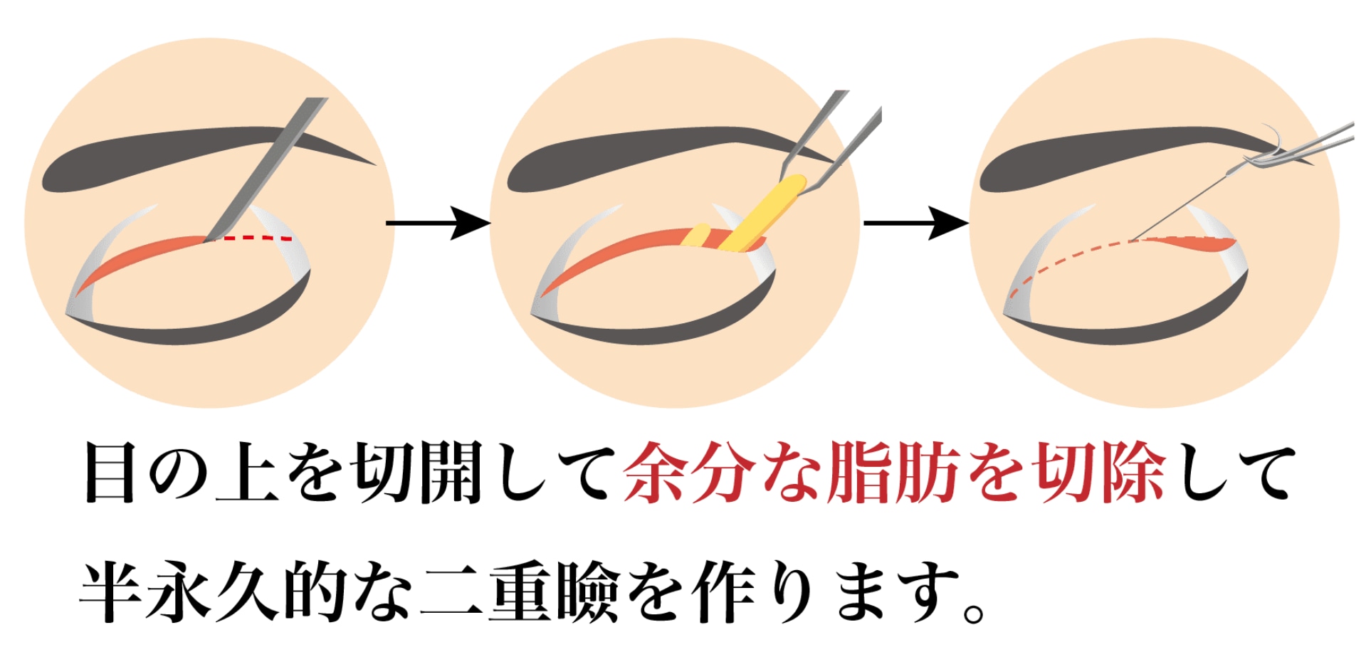 半永久的な二重術切開法