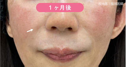 ヒアルロン酸のご予約