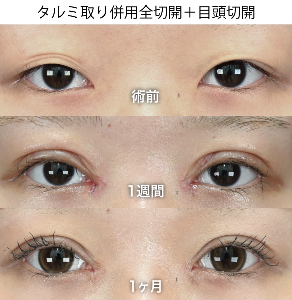 術後1ヶ月間の経過を紹介