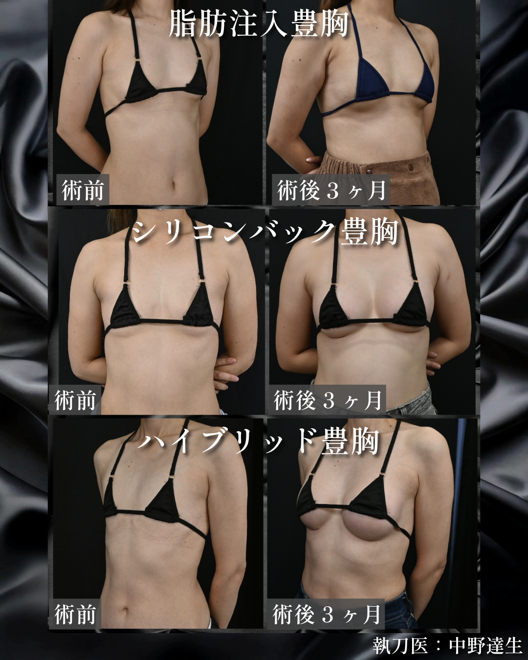 ３種類の豊胸術