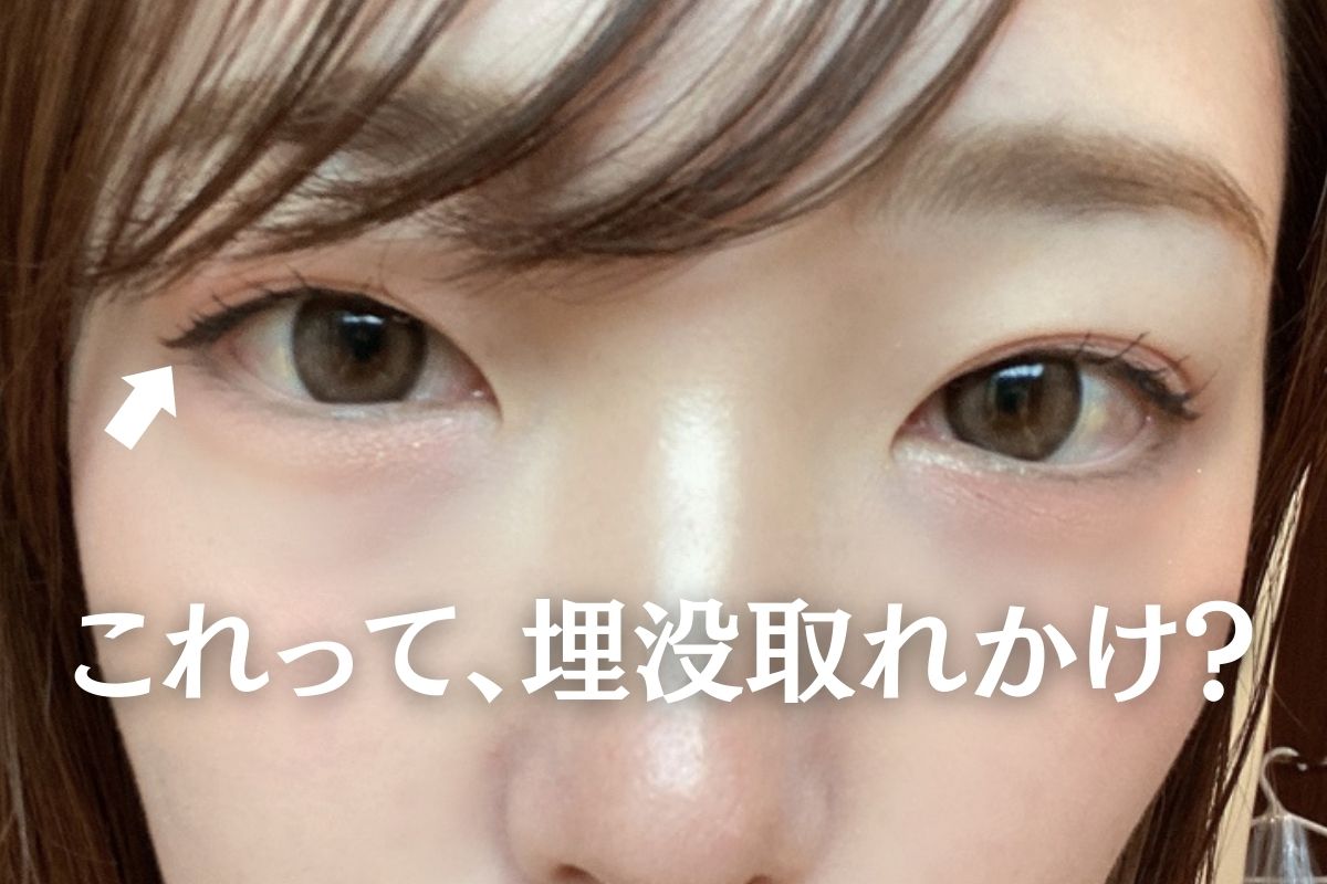 【最近、二重が安定しない…】それ埋没の取れかけかもしれません。
