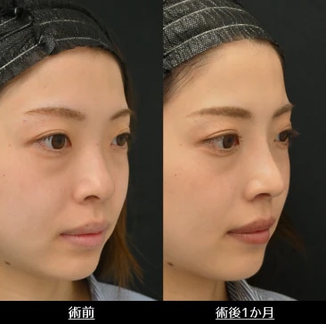 ソフトプロテーゼ(I型)/鼻尖形成術3D法/鼻尖部軟骨移植/小鼻縮小術(フラップ法)