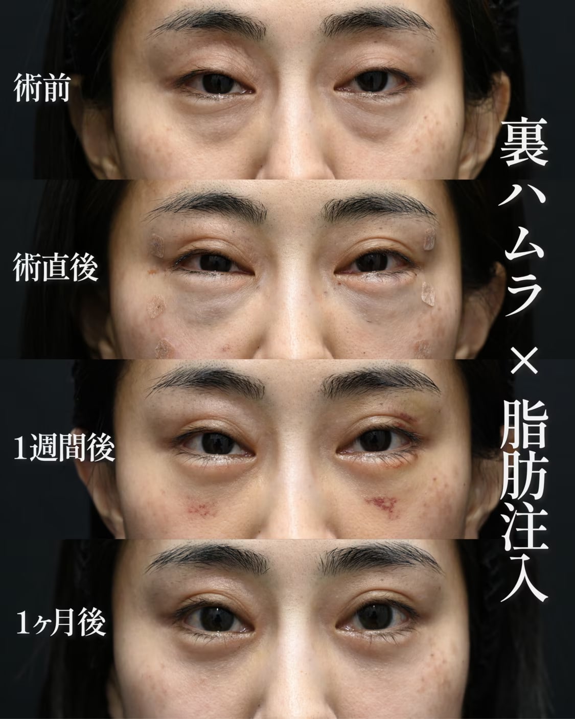クマ取りでどのくらい変わるのか？実際の症例をご紹介！