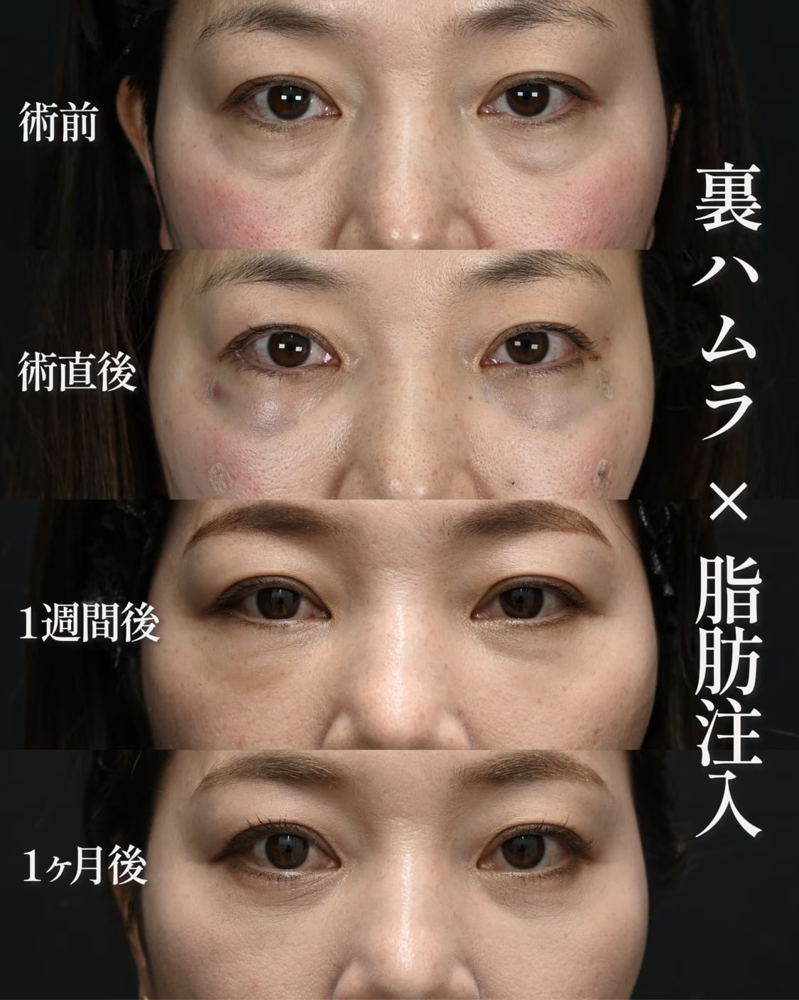 40代女性:インフルエンサー様の症例