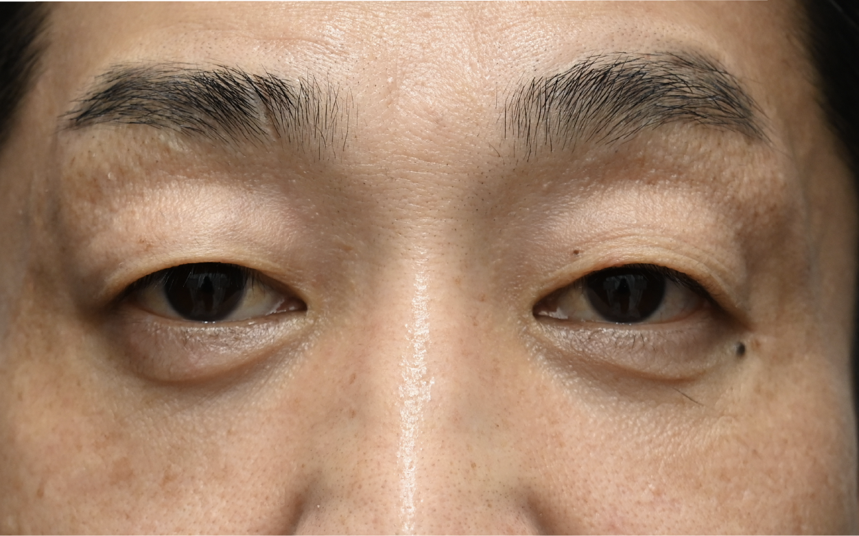 【中顔面も同時にリフトアップ】裏ハムラ法×ミッドフェイスリフト