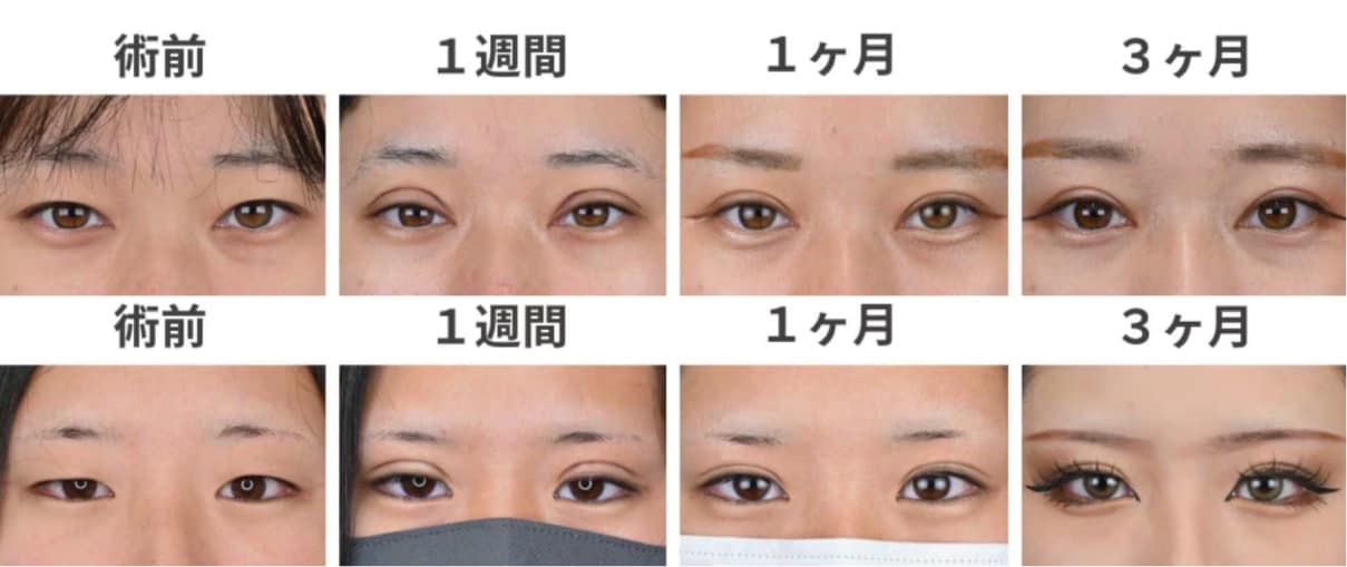 名古屋で二重全切開をやるなら中野医師