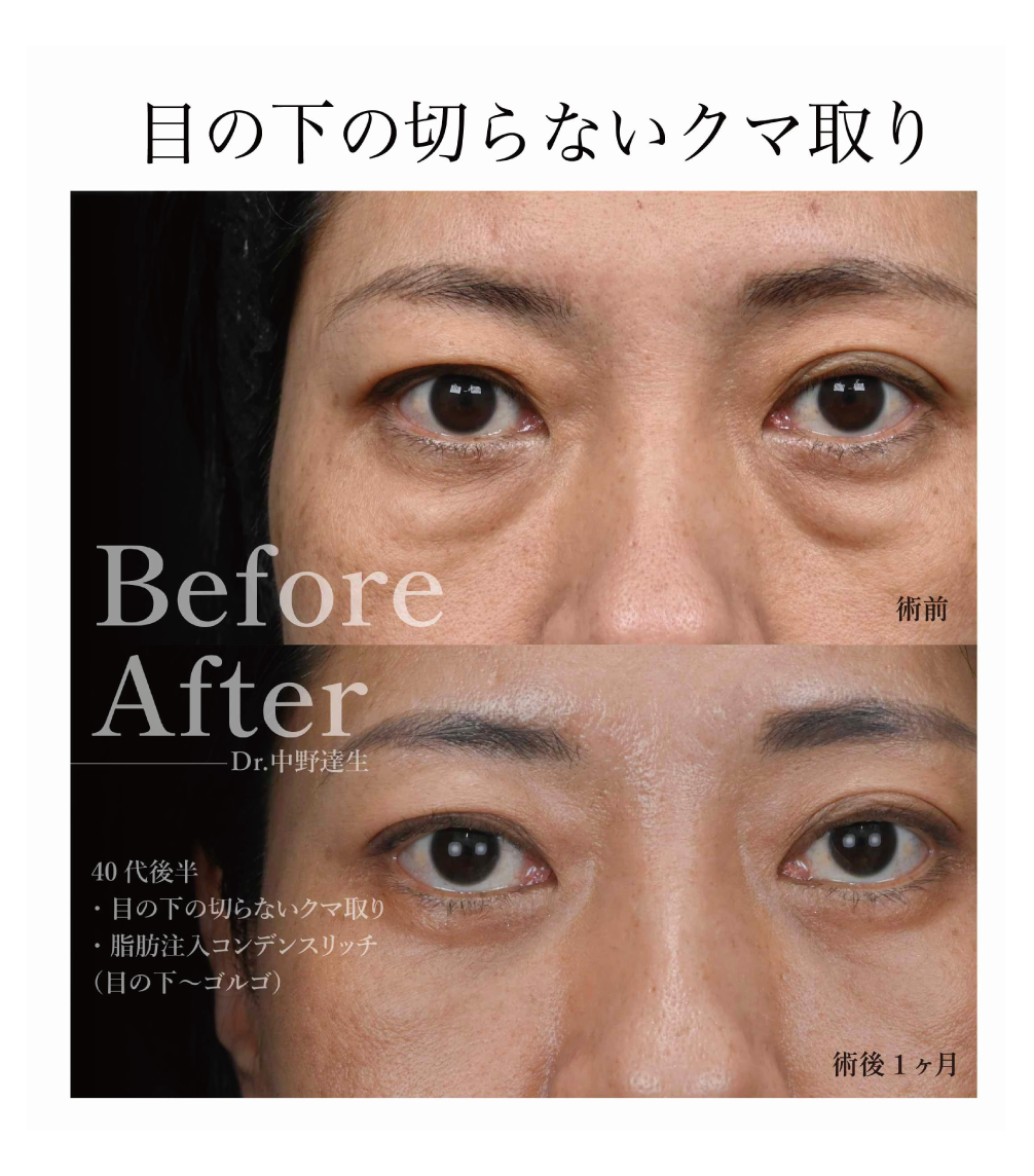 目の下の切らないクマ取り・たるみ取り(脱脂術）