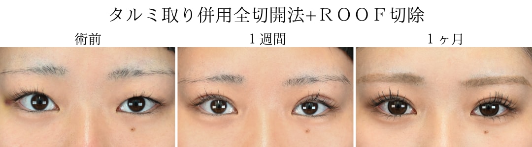 半永久的な美しい二重を手に入れる｜細部までこだわり抜く中野医師による「切開法」
