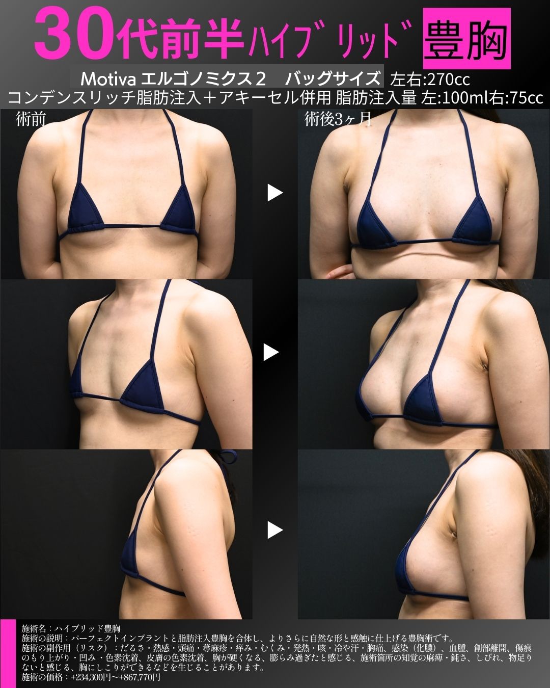 ハイブリッド豊胸