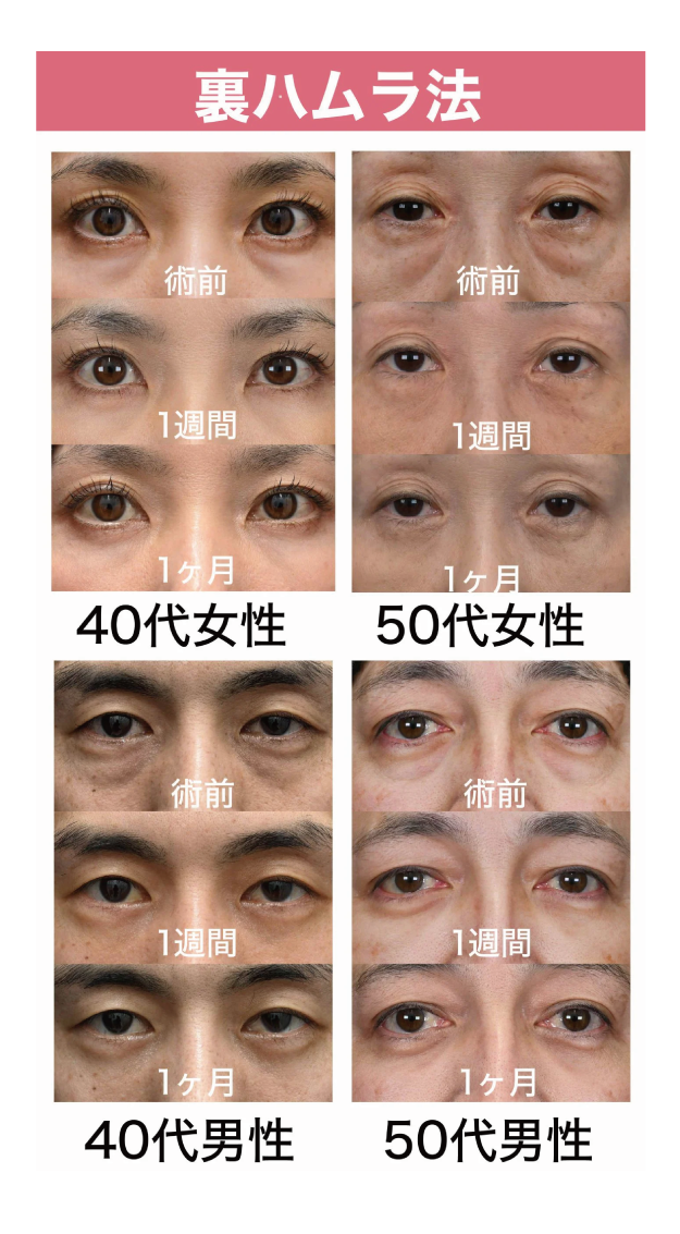 【裏ハムラ法】症例紹介