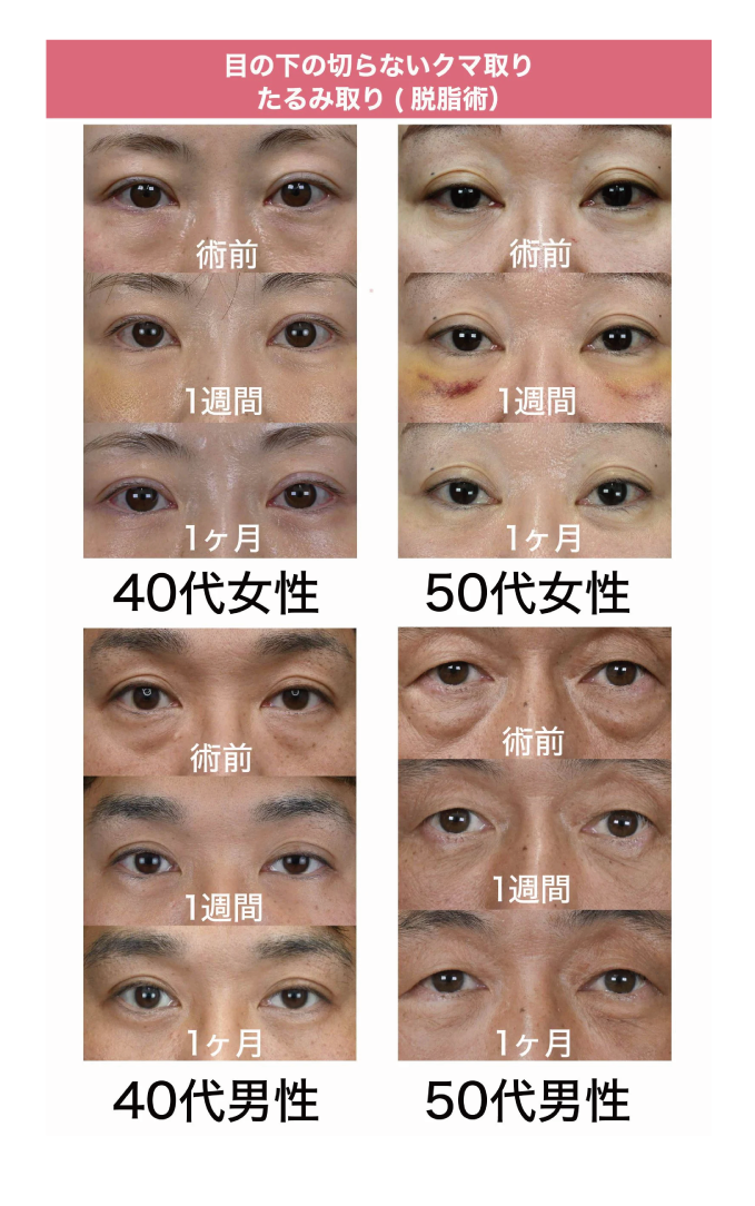 【目の下の切らないクマ取り・たるみ取り(脱脂術）】症例紹介