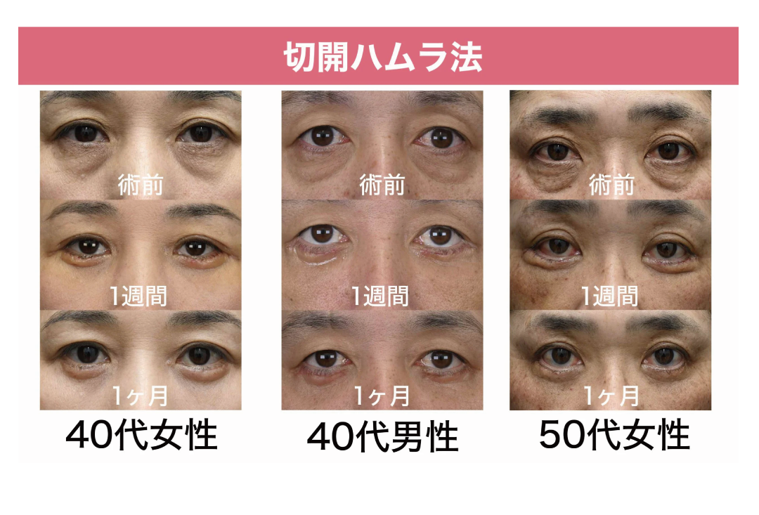 【切開ハムラ法】症例紹介