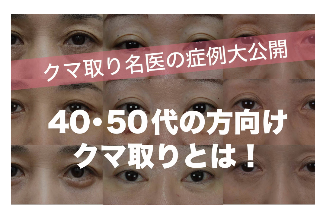 【症例公開】40〜50代の方向けクマ取り!!全国No.1のクマ取り名医が行った症例を施術別でご紹介