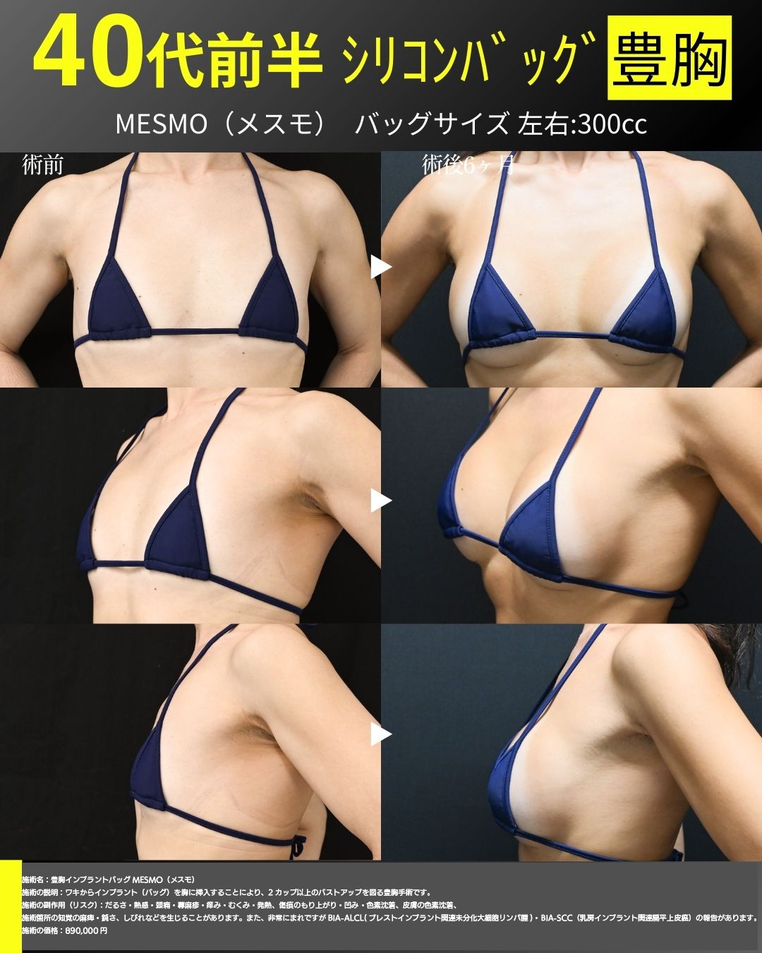 シリコンバッグ豊胸