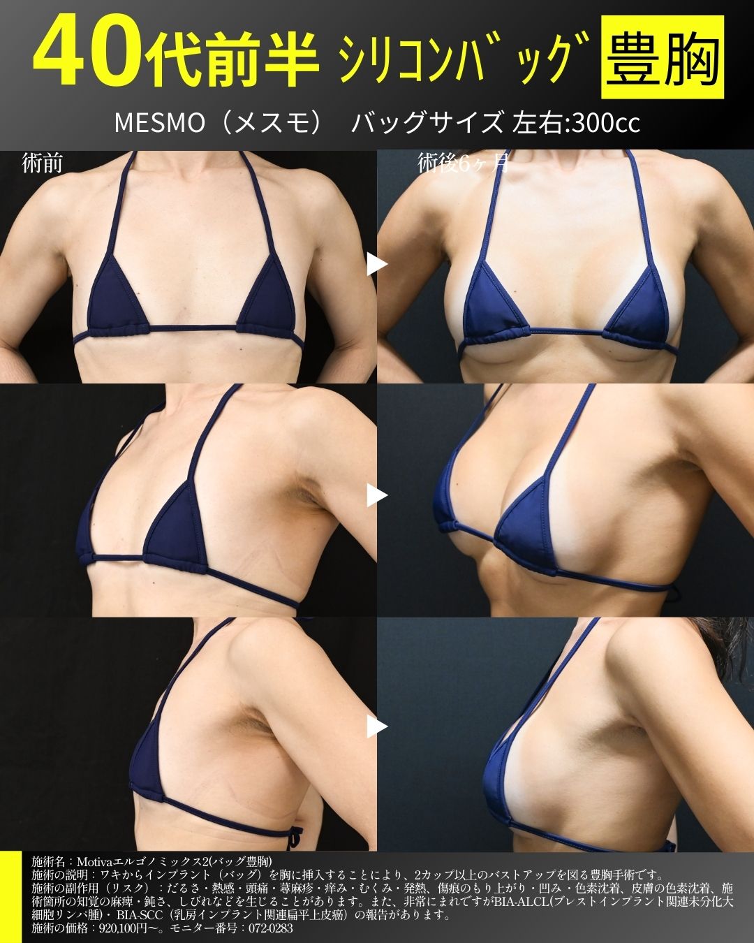 シリコンバッグ豊胸