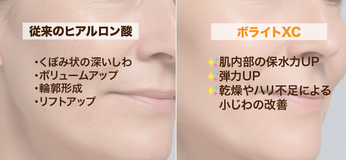 肌質改善ができるのがボライトXC