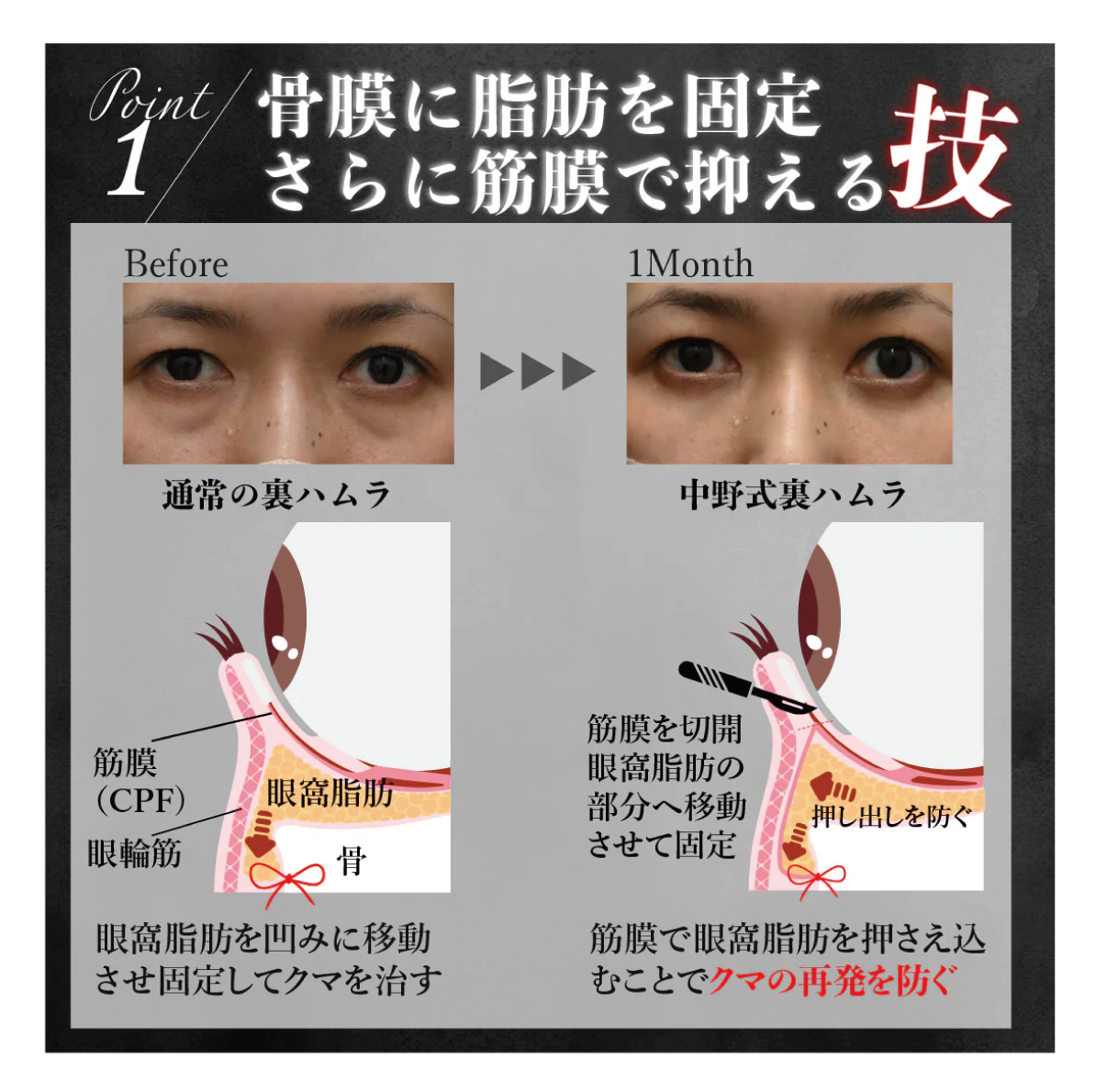 再発防止に特化した中野式裏ハムラ法