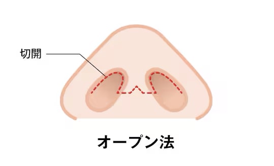 鼻尖形成術3D法の傷跡