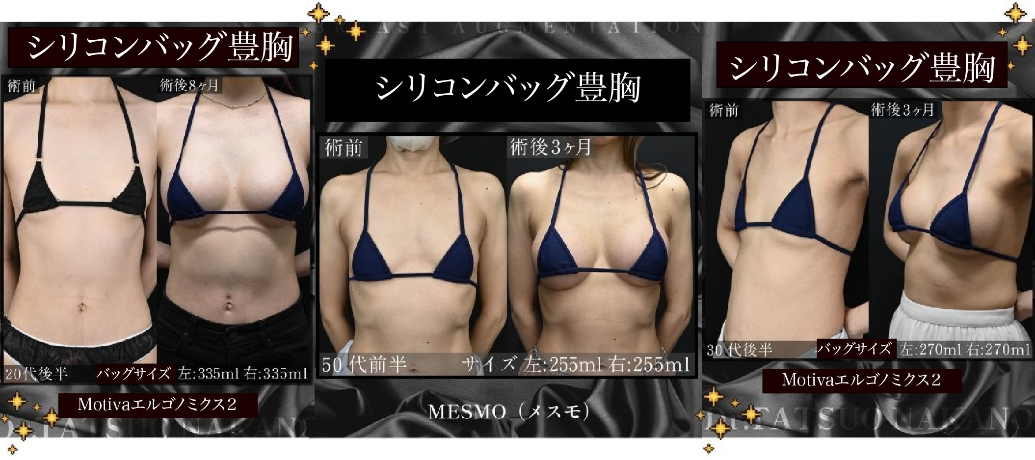 豊胸手術の種類とは？