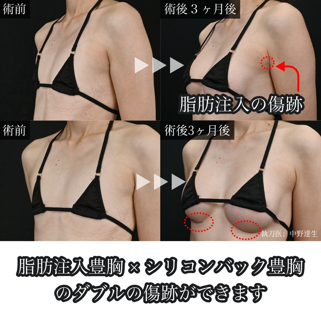 ハイブリッド豊胸手術の傷跡
