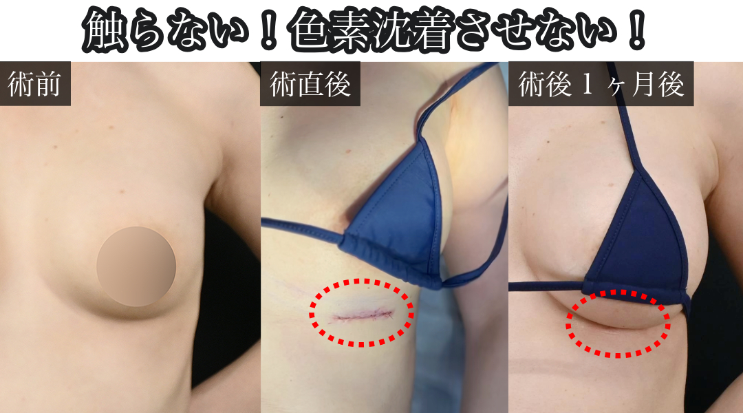 色素沈着させない！<br />
