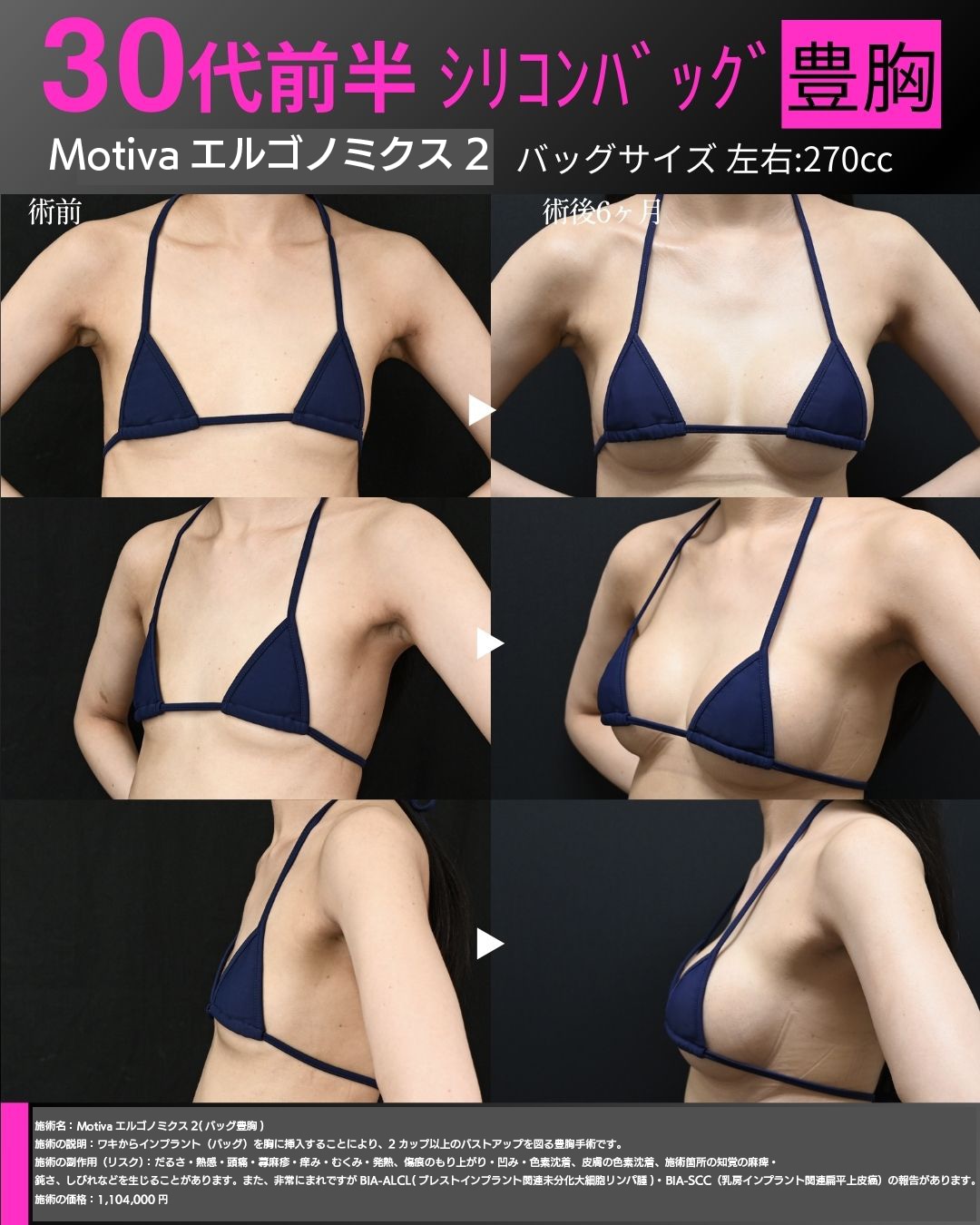シリコンバッグ豊胸