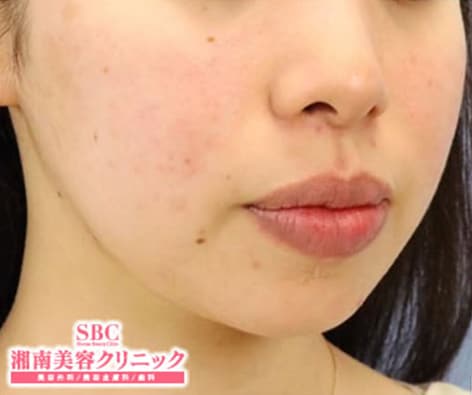 ピーリングのご予約