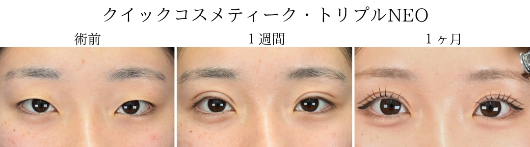 ダウンタイムが心配な方へ｜仕上がりの美しさと持ちを両立する埋没法