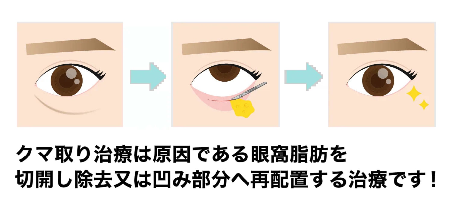 外科治療で目の下を切開するため