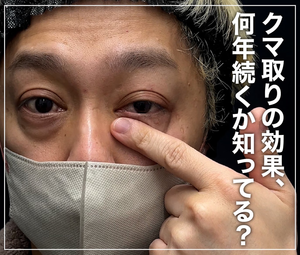 【クマ取り経過】クマ取りの効果はどれくらい持続する?10年後まで”もち”が継続する治療教えます!