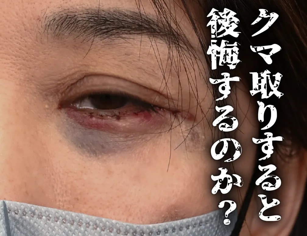 【クマ取り失敗!?】クマ取りで後悔しないためのポイントと失敗する原因を解説！